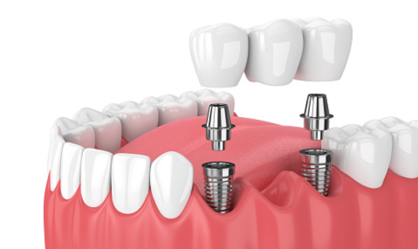 Why You Should Get Dental Implants To Restore Your Smile?