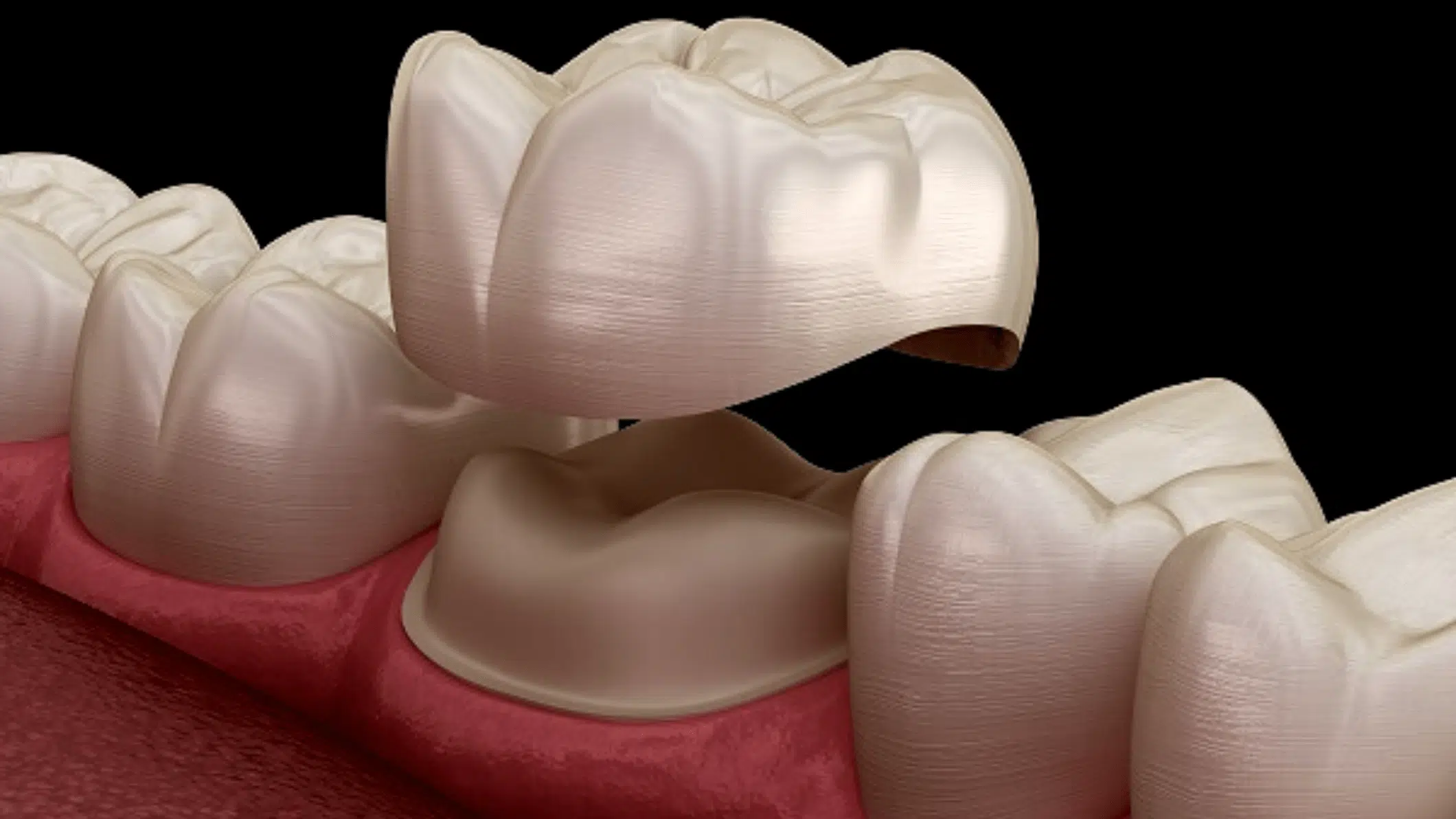 Dental Crowns Garland