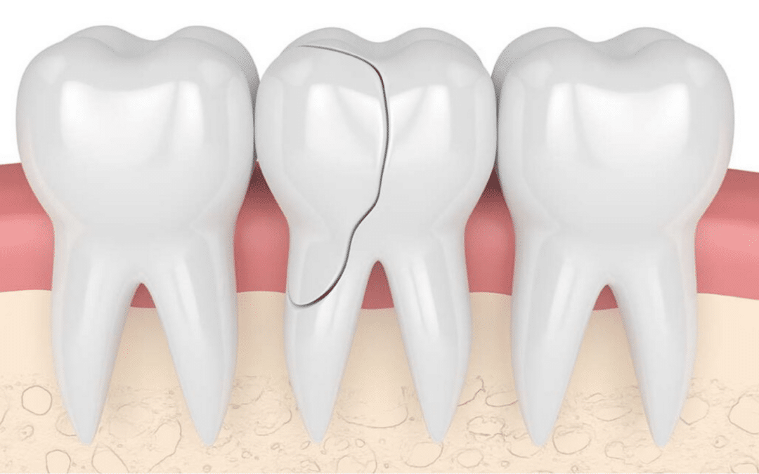The Best Ways To Treat Cracked Teeth And Restore Your Smile