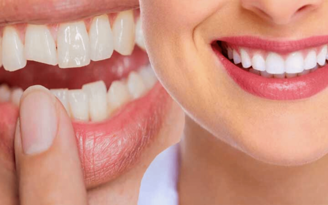 Can Cosmetic Bonding Give You Back A Healthy Smile?