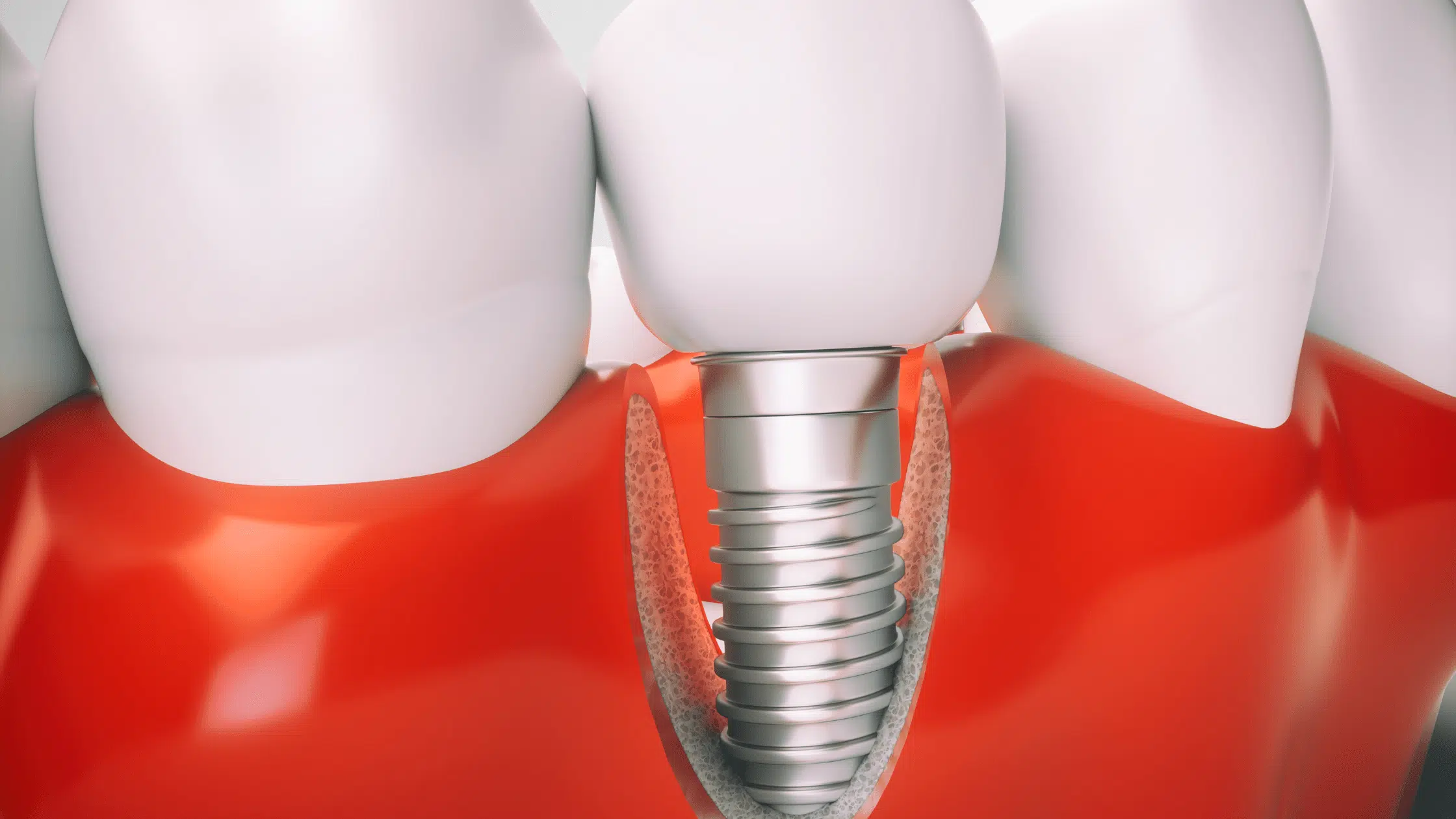 Dental Implants in Garland