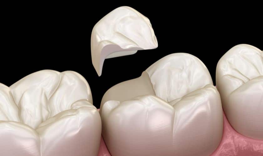 cracked teeth treatment in garland