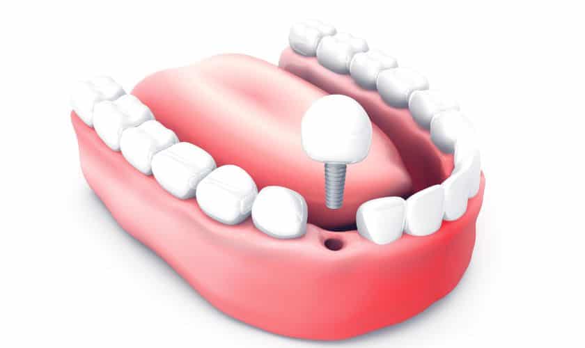 dental implants in garland
