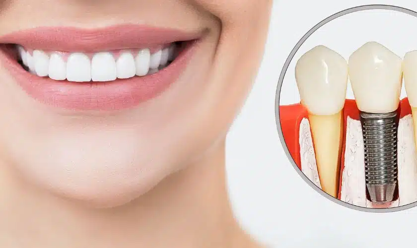 dental implants garland