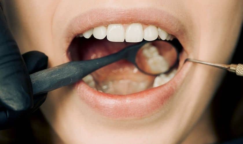 Teeth Whitening