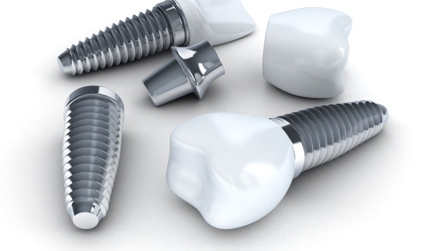 How to Care for Your Dental Implants: Dos and Don’ts