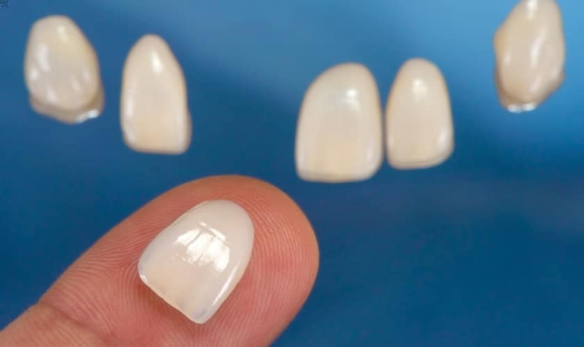 Sample of Dental Veneers