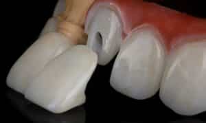 Sample of Dental Veneers