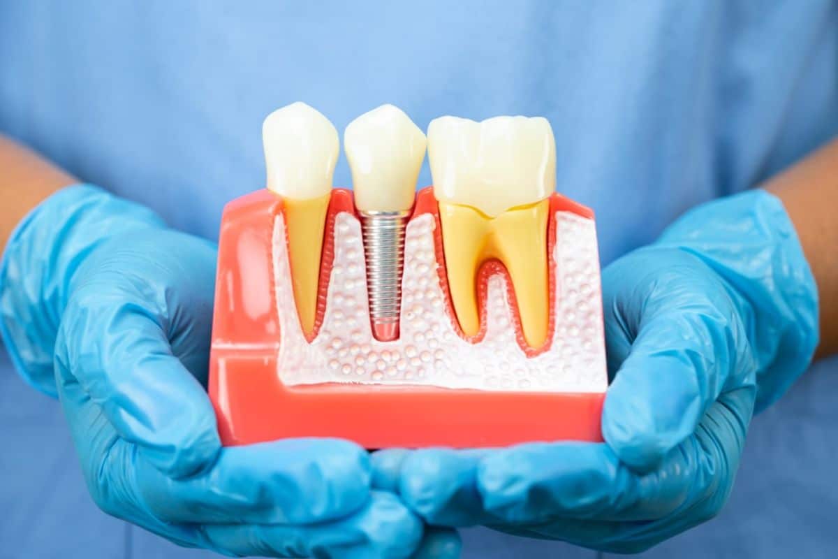 Model of Dental Implants.